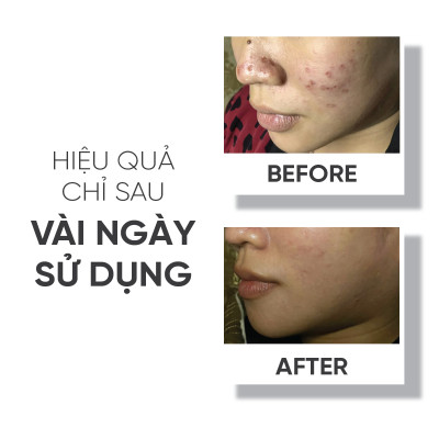Bộ sản phẩm dành cho da mụn Lá House Acne Control gồm 2 món Serum và Toner 10ml&30ml